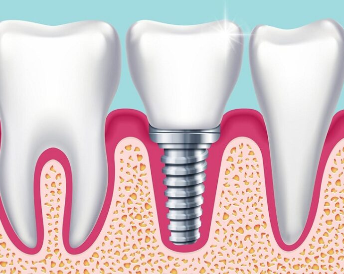 Full Mouth Rehabilitation