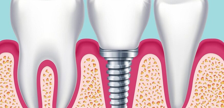 Full Mouth Rehabilitation